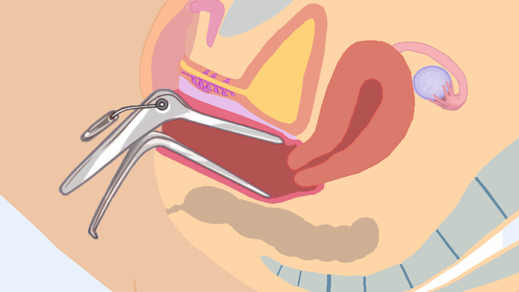 Researchers redesign vaginal speculum to ease fear and pain