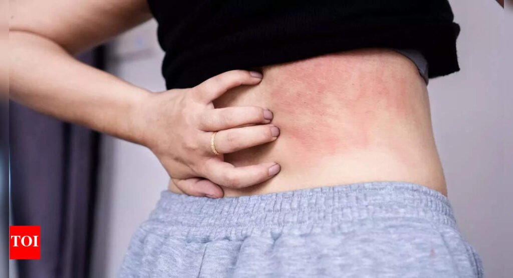 What is Disney rash: Symptoms and prevention explained |
