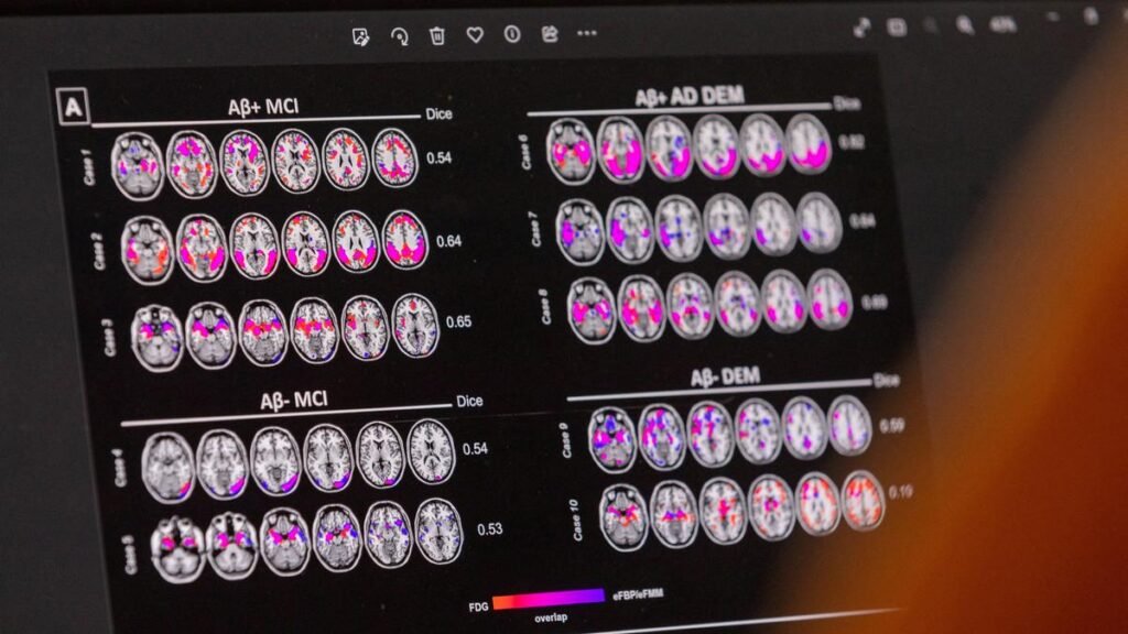 Researchers say routine eye tests may reveal signs of Alzheimer's before symptoms appear