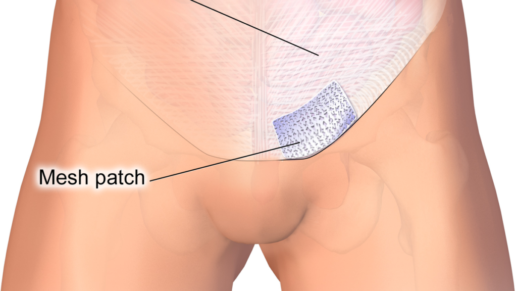 Ignoring that bulge could cost you: here’s what you should know about hernias