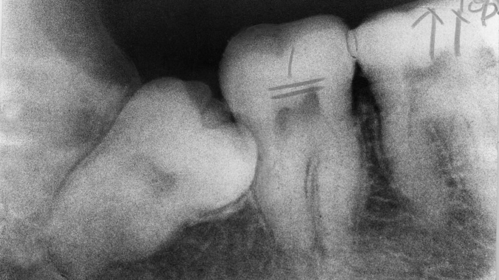 Why do people have baby teeth and adult teeth? Why do people have baby teeth and adult teeth?